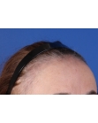 Before Hair Transplant&nbsp;Hairline